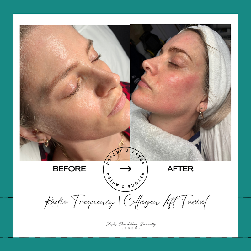 Rejuvenate Your Skin with Collagen Lift: A Complete Guide to Radio Frequency (RF) Facials